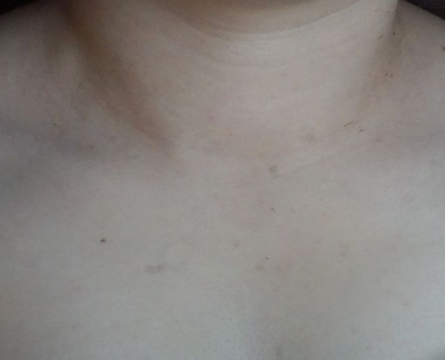 사마귀 치료 전