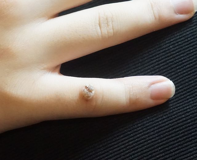 사마귀 치료 전