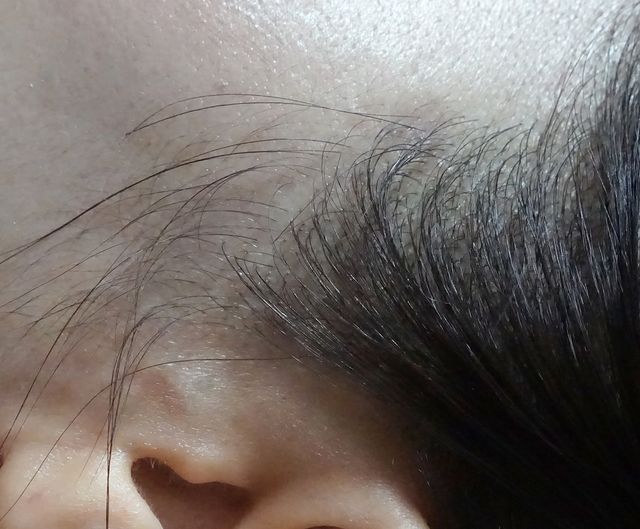 50세 여성 · 4개월 경과
