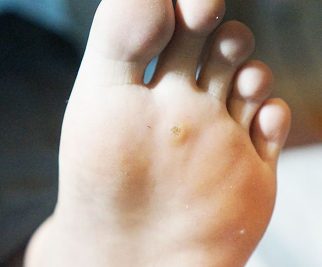 사마귀 치료 전
