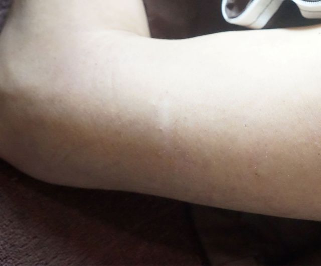 58세 남성 · 12개월 경과