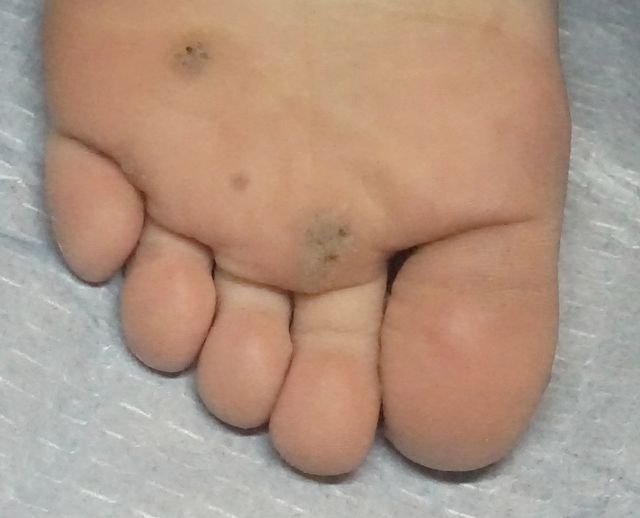 사마귀 치료 전