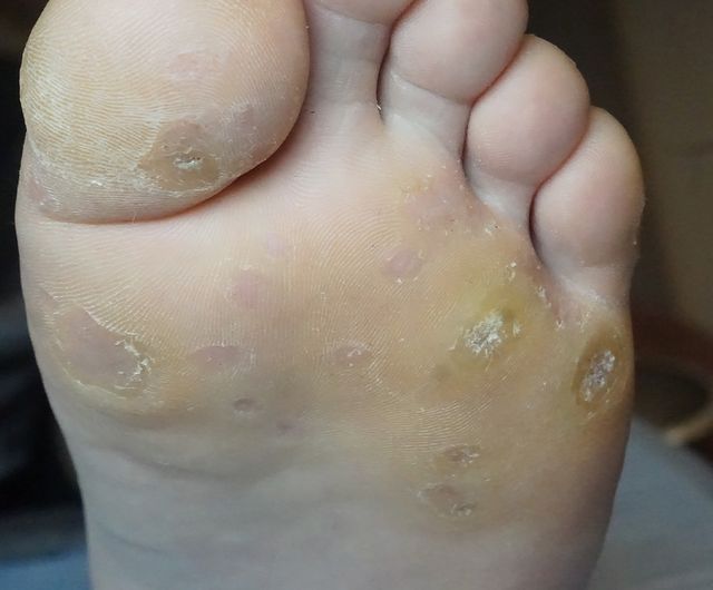 사마귀 치료 전
